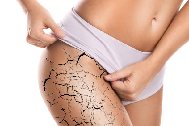 HEALING FOR STRETCH MARKS